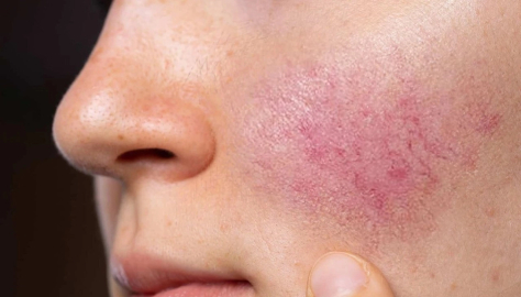 Gül hastalığı ihmal edilmemeli