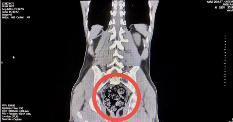 İranlı kurye uyuşturucuyu makatında saklamış!