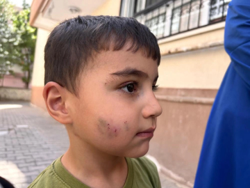 Ankara'da uyuyan çocuğu lağım faresi ısırdı