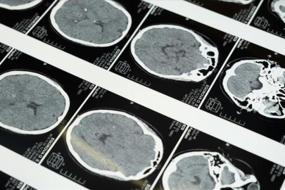 Uzmanlardan masajla gelen inme uyarısı