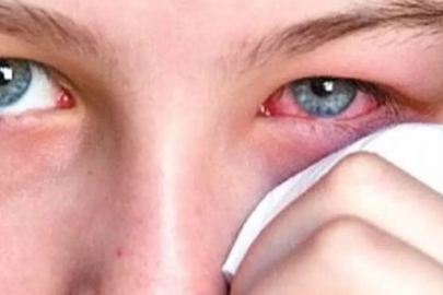 Uzmanı uyardı: Kışla birlikte gelen göz enfeksiyonlarına dikkat