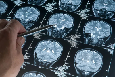 Yeni bir hastalık keşfedildi: Yalnızca 13 kişide görüldü