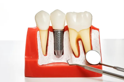 Diş tedavisinde yeni dönem: İmplant SSK kapsamına giriyor