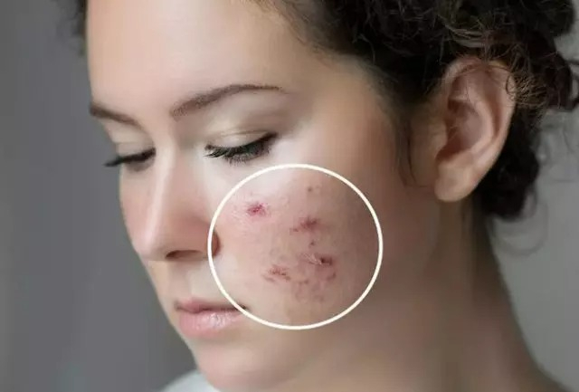 2. Cildi aşırı veya yanlış temizlemek