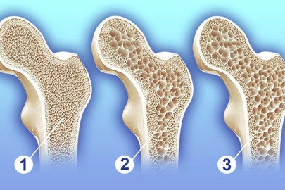 Sessiz ilerleyen risk osteoporoz