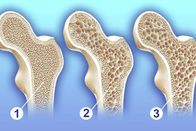 Sessiz tehlike: "Osteoporoz"