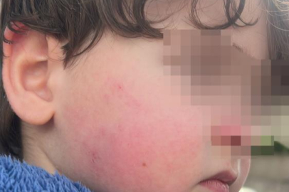 Kreşe bıraktığı çocuğunu darp edilmiş halde aldı