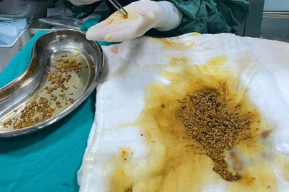 Doktorlar bile şaşkın: Hastadan 2 binden fazla taş çıkarıldı