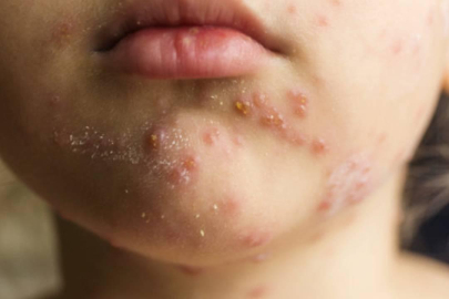 Prof. Dr. Kara'dan "kızamık" uyarısı: Bir kişi 18 kişiye bulaştırabilir