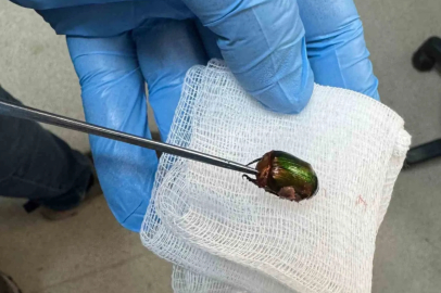 Ağrı ve işitme kaybı nedeniyle hastaneye gitti, kulağından Japon böceği çıktı